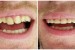 dentist abroad, dental holiday, dentist greece, dentist crete , dentist hersonissos, dentist malia, stalis, analipsi, piscopiano, koutouloufari, Chersonisos, gouves