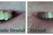 zirconium crown, Zirconium bridge, low cost dental bridge, cheap dental crown, cerec crown,dentist abroad, dental holiday, dentist greece, dentist crete , dentist hersonissos, dentist malia, stalis, analipsi, piscopiano, koutouloufari, Chersonisos, gouves