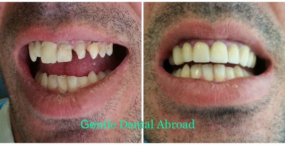 Greece dentist, oth implants Greece, tooth implant Greece, cosmetic dentist in greece, tooth crown Greece, teeth implants, Greece teeth implant, Greece teeth crown, Greece teeth bridge, Greece medical tourism Greece, greek medical tourism, Greece tooth